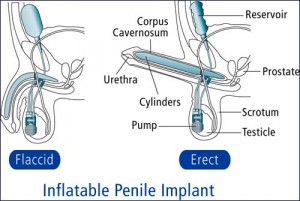 Common side effects of testosterone injections