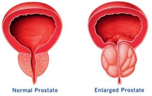 Prostate Enlargement Prostate Enlargement