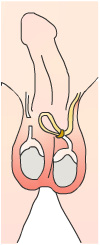 Vasectomy