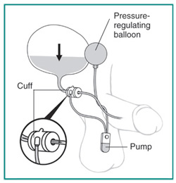 Urinary Sphincter