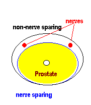 prostate-non-nerve-sparing-operation