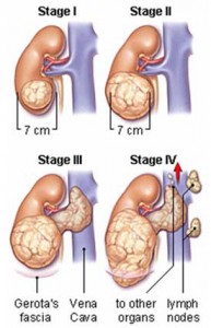 cancer kidney renal basic