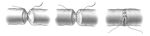 stitching-vasectomy-reversal