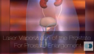 Laser Vaporization for Prostate Enlargement