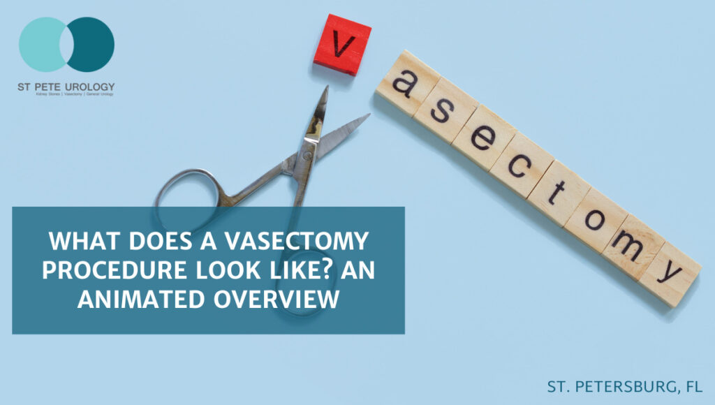 What Does a Vasectomy Procedure Look Like? An Animated Overview St Pete Urology